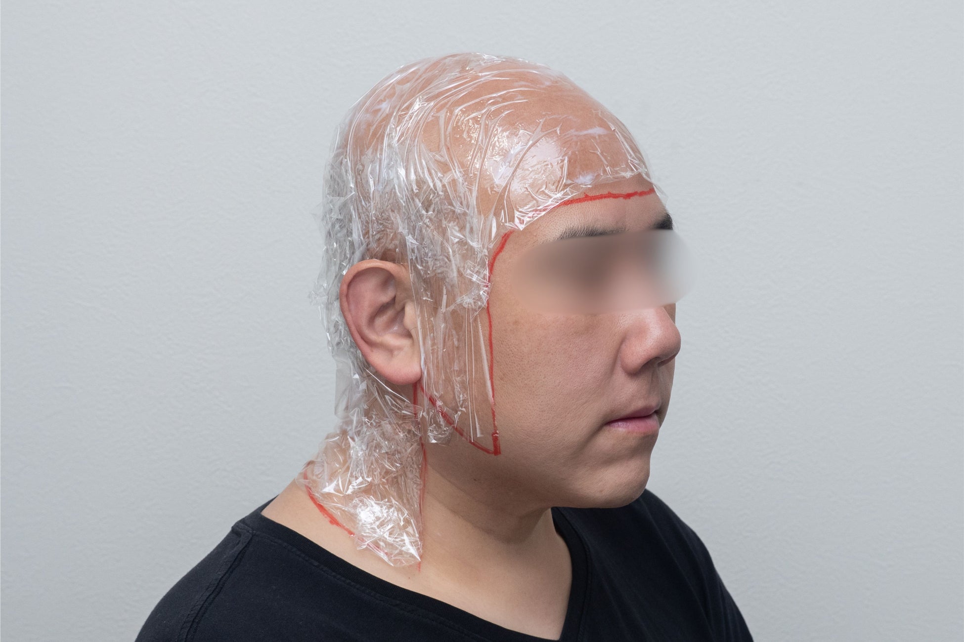 定期的に剃髪する男性向けの新治療「スキンヘッド脱毛」が2026年に登場