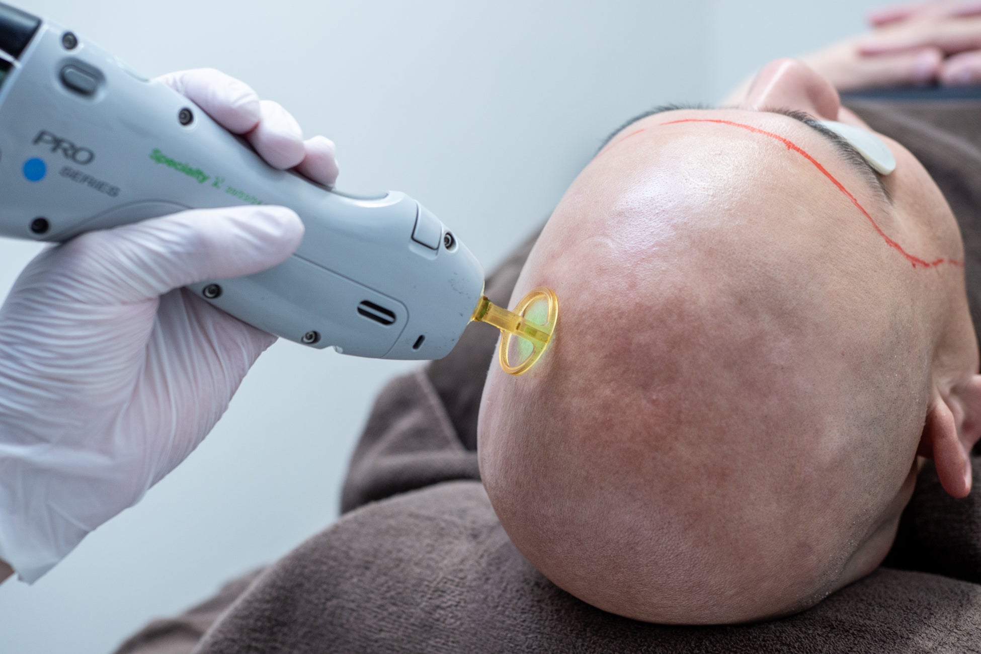 定期的に剃髪する男性向けの新治療「スキンヘッド脱毛」が2026年に登場
