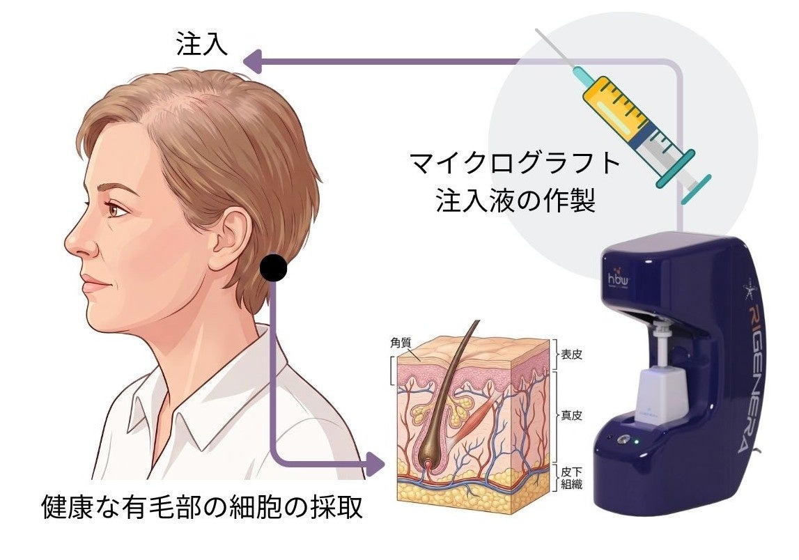 自己の皮膚組織を頭皮に注入する薄毛治療「マイクログラフト薄毛療法」が提供開始