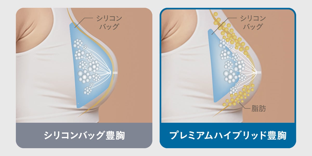 豊胸経験者の約7割が「バレたかも」と不安に シリコンと脂肪のハイブリッド施術が5院で提供開始